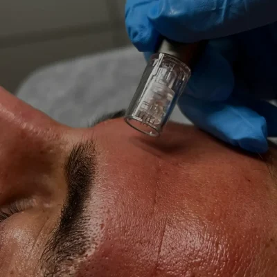 Microneedling